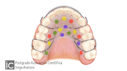Ilustración aparato ortodoncia vega asensio