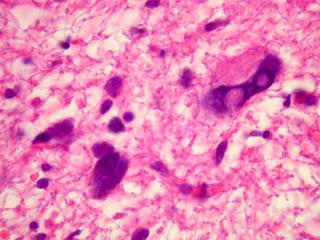 Imagen micorscópica de un glioma