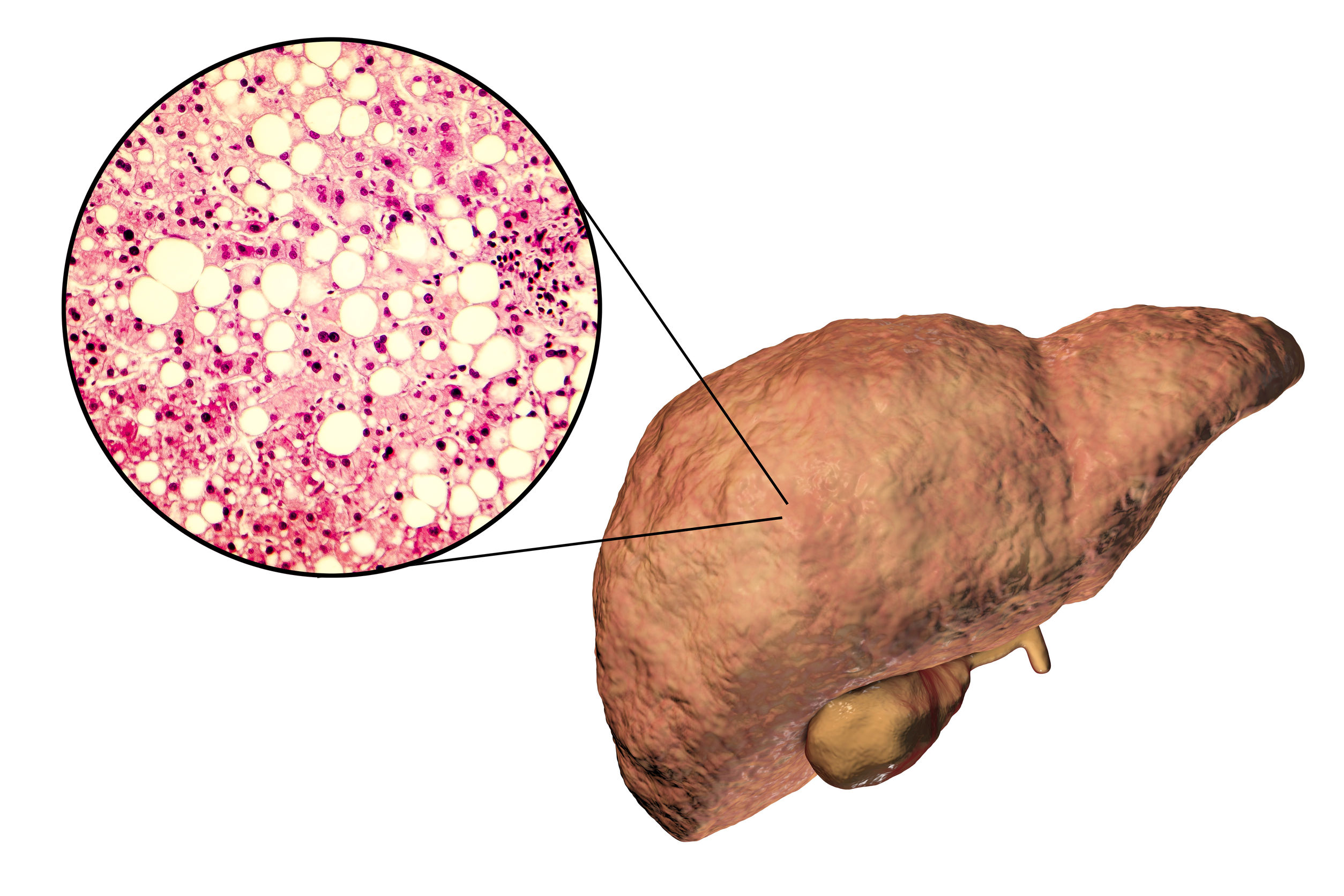 Targeting non-alcoholic fatty liver disease