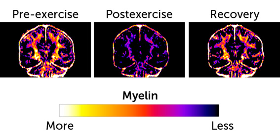 Niveles de mielina en el cerebro de los corredores