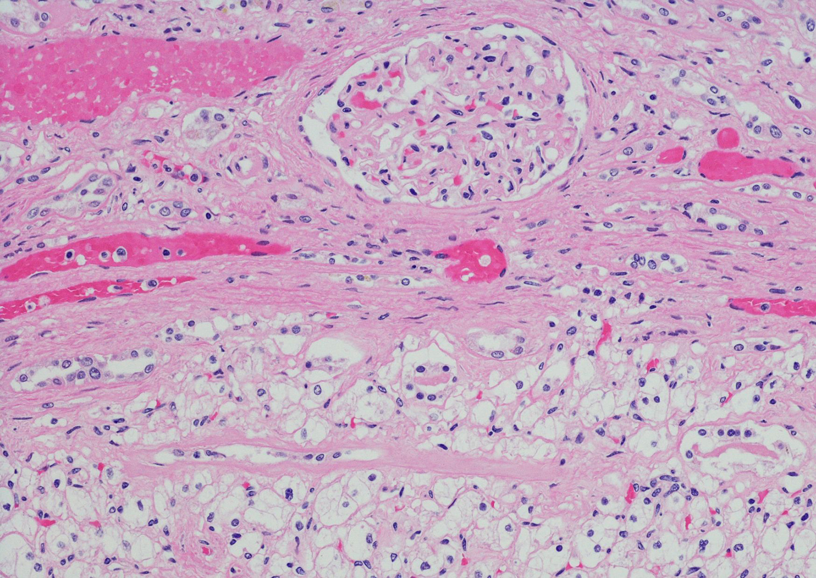 Las matemáticas, la histopatología y la genómica convergen para confirmar que los carcinomas renales de células claras altamente agresivos muestran bajos niveles de heterogeneidad intratumoral. (CANVA)