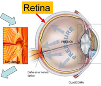 Dí­a Mundial del Glaucoma