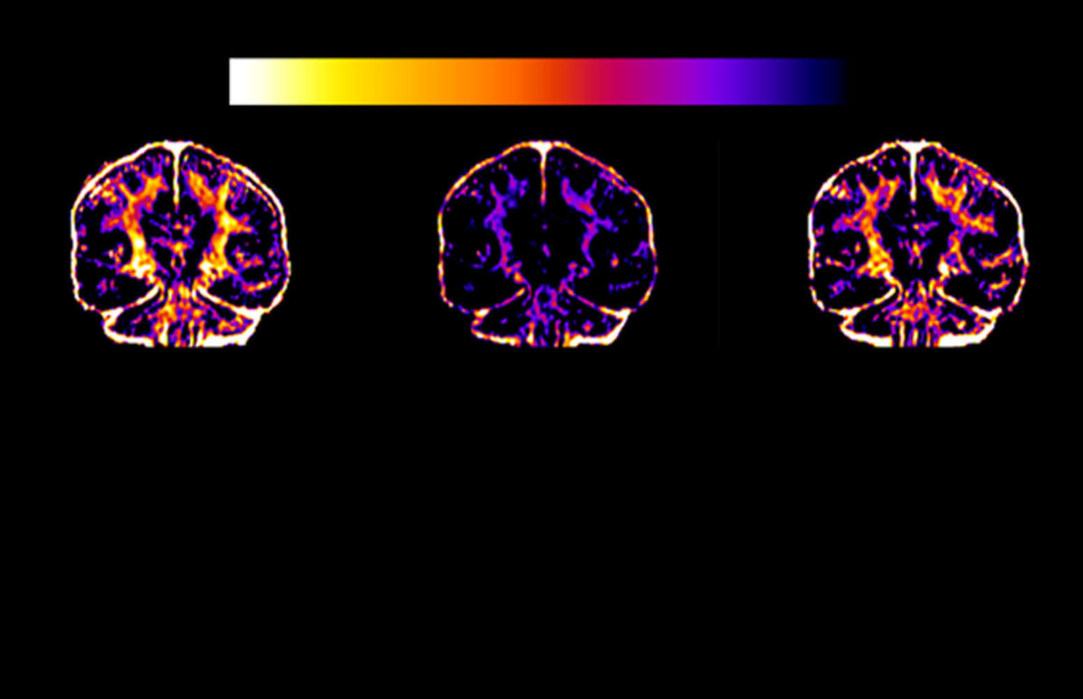 Myelin levels in the brain of runners