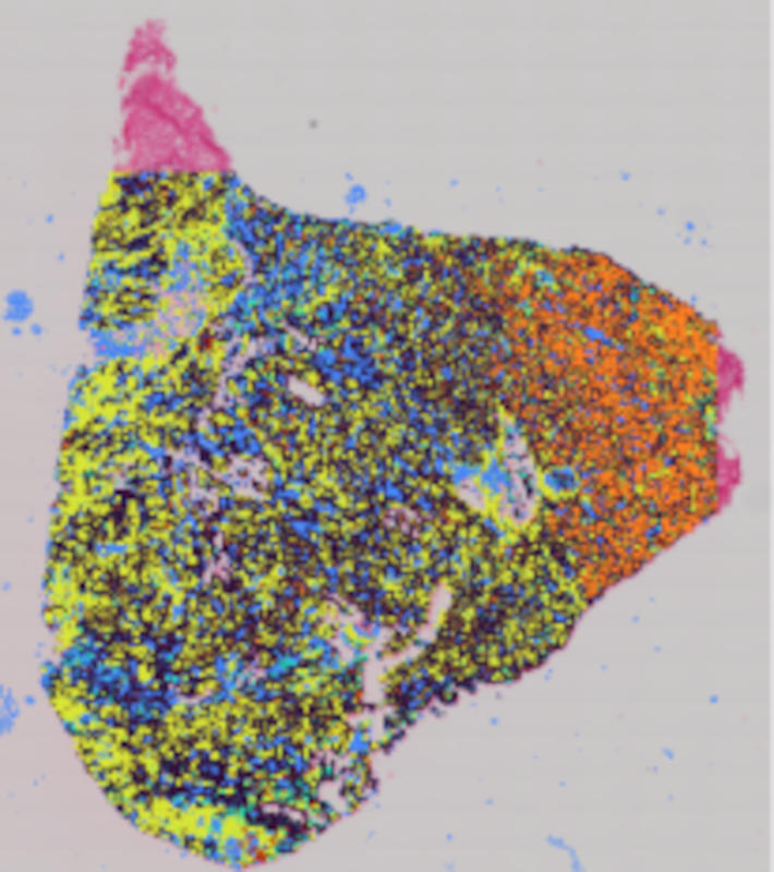 ccRCC ccRCC_0m239_8um