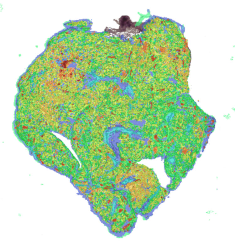 ccRCC 293T_008um.jpg