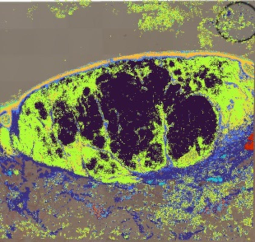 Melanoma melanoma_M337_008um