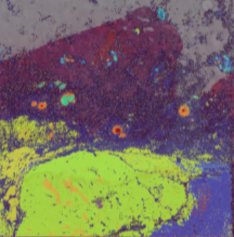 Melanoma muestra21T-008um
