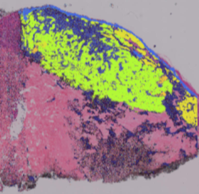 Melanoma melanoma_25T_008um